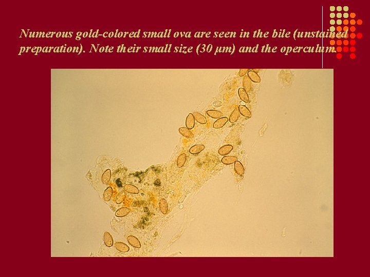 Numerous gold-colored small ova are seen in the bile (unstained preparation). Note their small Numerous gold-colored small ova are seen in the bile (unstained preparation). Note their small