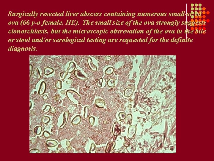 Surgically resected liver abscess containing numerous small-sized ova (66 y-o female, HE). The small Surgically resected liver abscess containing numerous small-sized ova (66 y-o female, HE). The small
