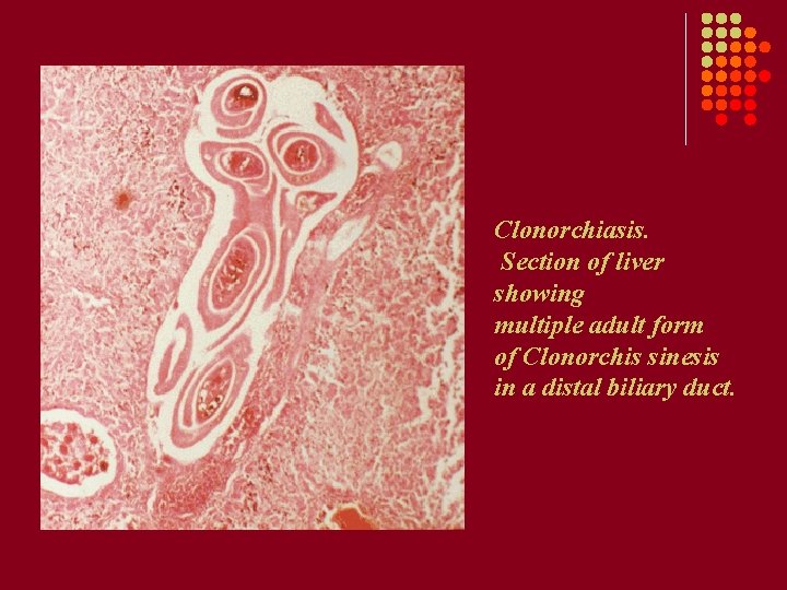 Clonorchiasis. Section of liver showing multiple adult form of Clonorchis sinesis in a distal Clonorchiasis. Section of liver showing multiple adult form of Clonorchis sinesis in a distal