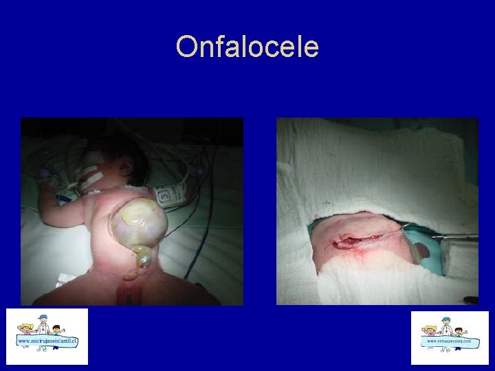 Onfalocele 