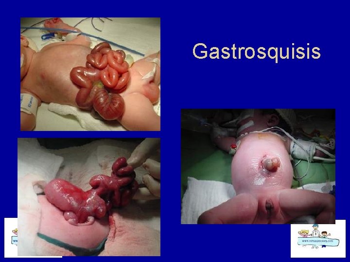 Gastrosquisis 