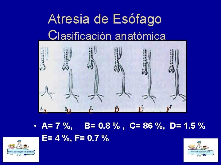 Atresia de Esófago Clasificación anatómica A B C D E F • A= 7