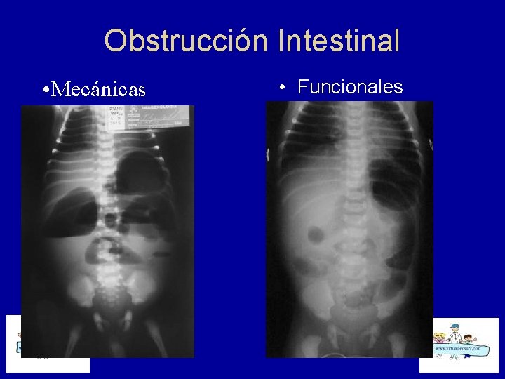 Obstrucción Intestinal • Mecánicas • Funcionales 