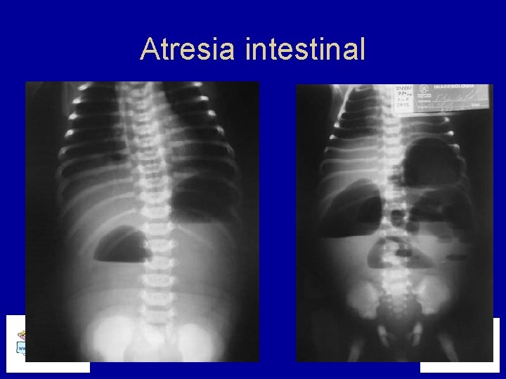 Atresia intestinal 