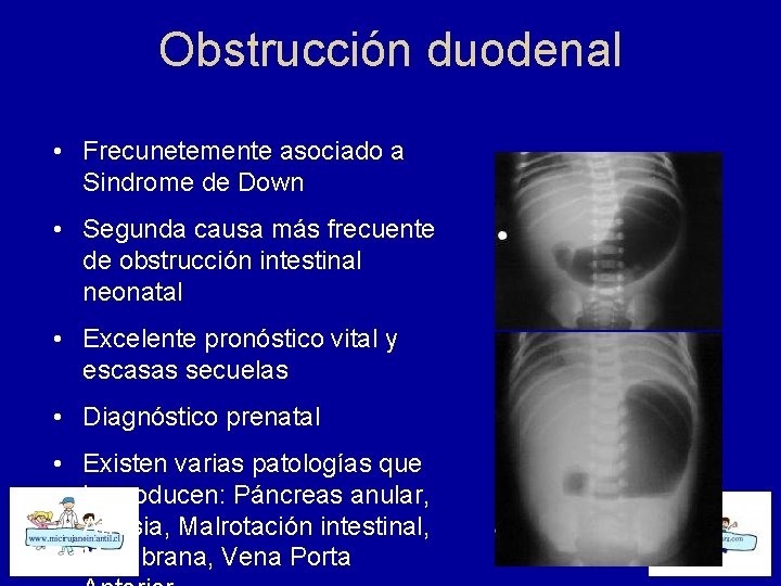 Obstrucción duodenal • Frecunetemente asociado a Sindrome de Down • Segunda causa más frecuente