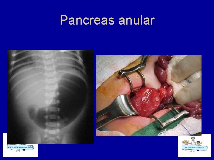 Pancreas anular 