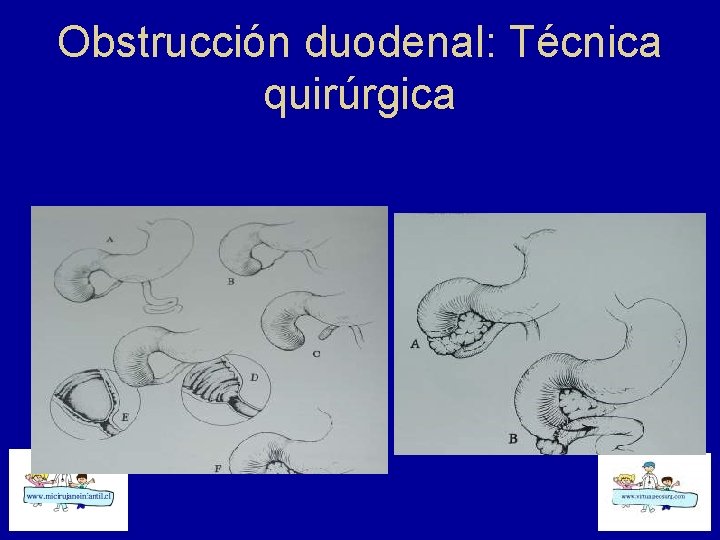 Obstrucción duodenal: Técnica quirúrgica 