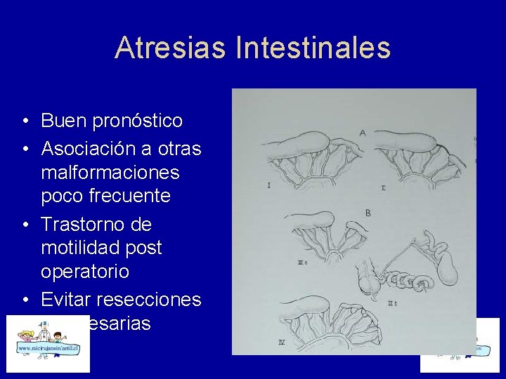 Atresias Intestinales • Buen pronóstico • Asociación a otras malformaciones poco frecuente • Trastorno