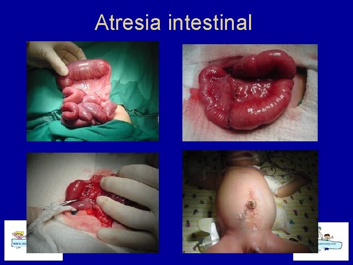 Atresia intestinal 