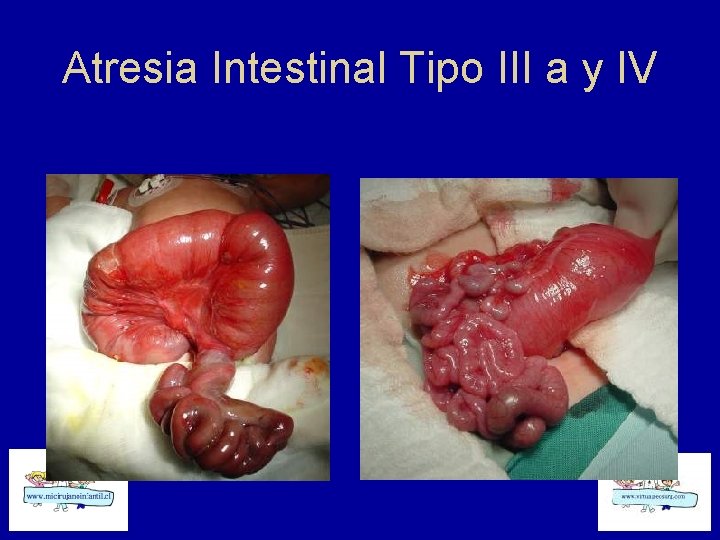 Atresia Intestinal Tipo III a y IV 