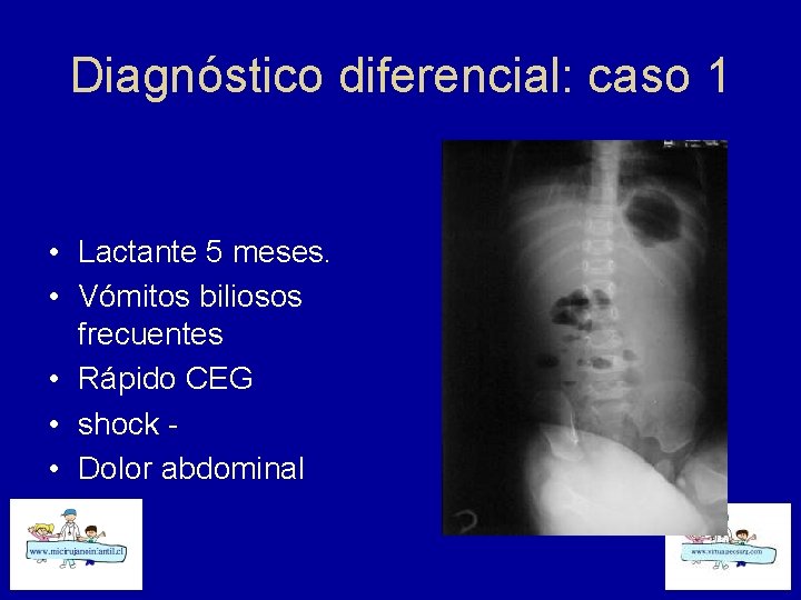 Diagnóstico diferencial: caso 1 • Lactante 5 meses. • Vómitos biliosos frecuentes • Rápido