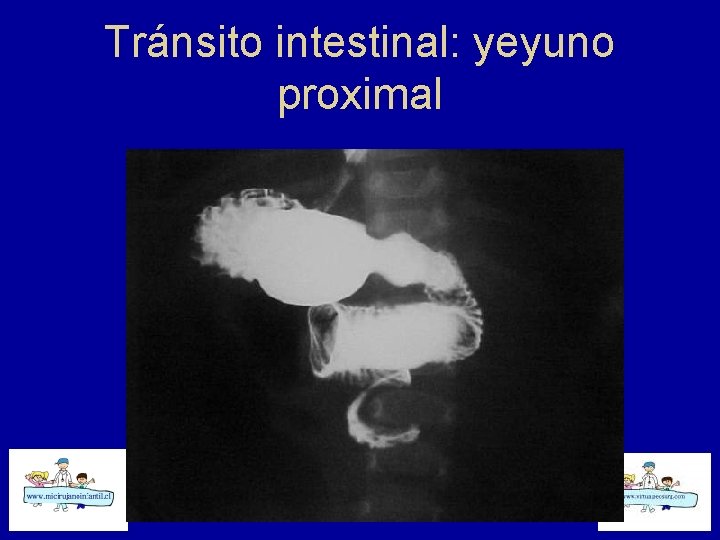 Tránsito intestinal: yeyuno proximal 