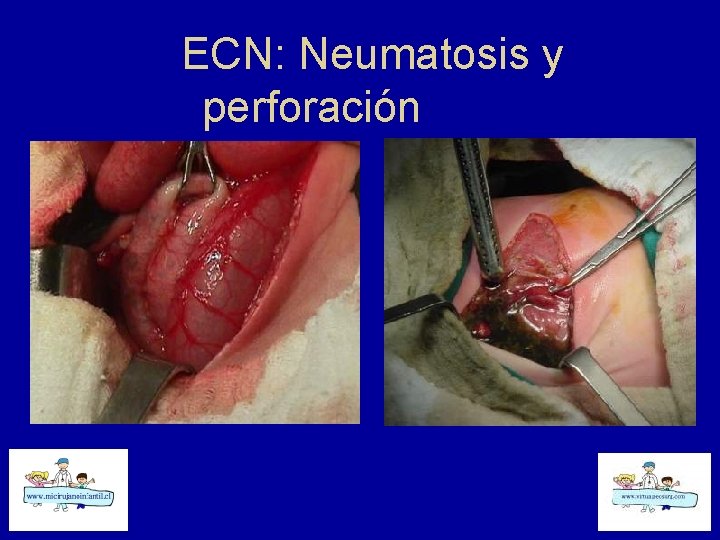 ECN: Neumatosis y perforación 