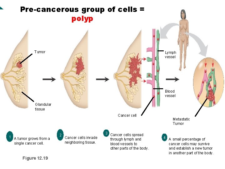 Pre-cancerous group of cells = polyp Tumor Lymph vessel Blood vessel Glandular tissue Cancer Pre-cancerous group of cells = polyp Tumor Lymph vessel Blood vessel Glandular tissue Cancer