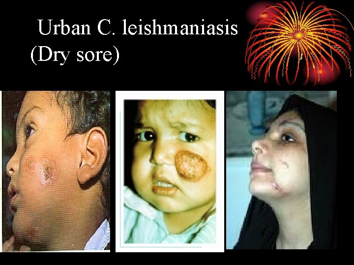 Urban C. leishmaniasis (Dry sore) 