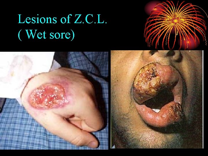 Lesions of Z. C. L. ( Wet sore) 