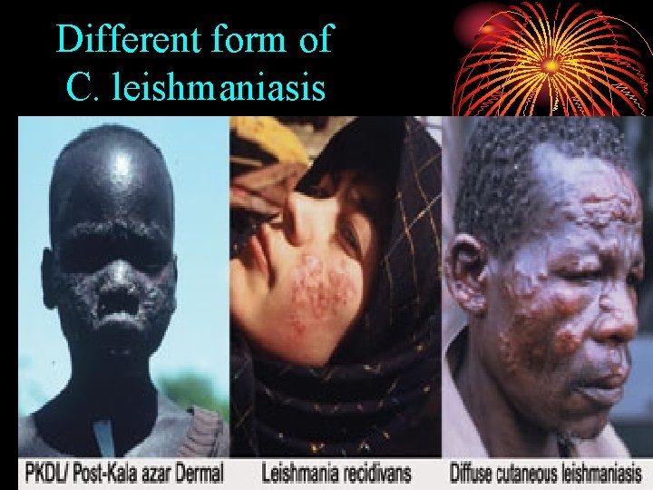 Different form of C. leishmaniasis 