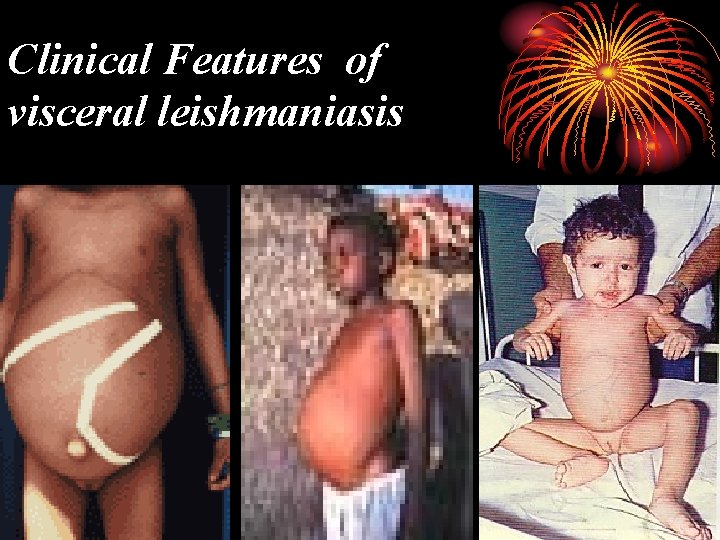 Clinical Features of visceral leishmaniasis 