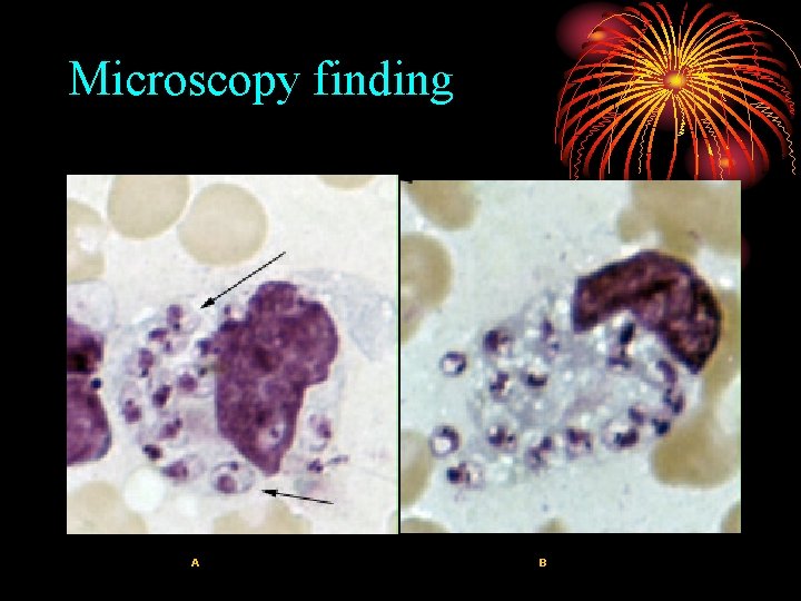 Microscopy finding A B 