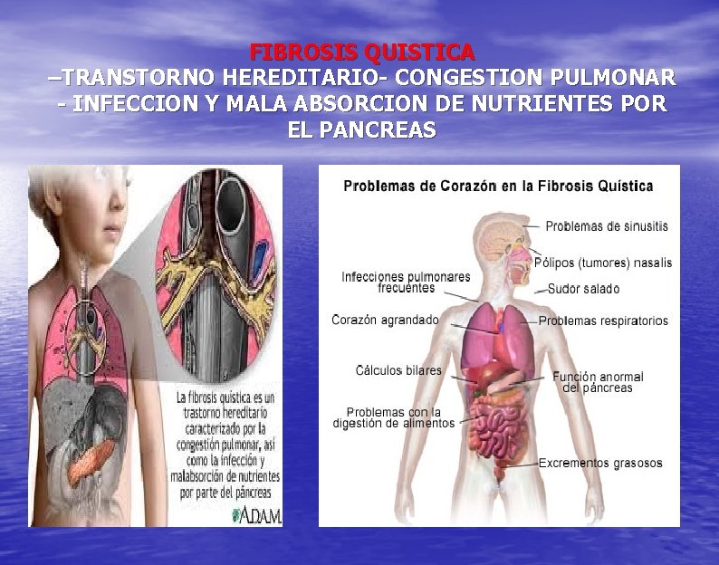 FIBROSIS QUISTICA –TRANSTORNO HEREDITARIO- CONGESTION PULMONAR - INFECCION Y MALA ABSORCION DE NUTRIENTES POR