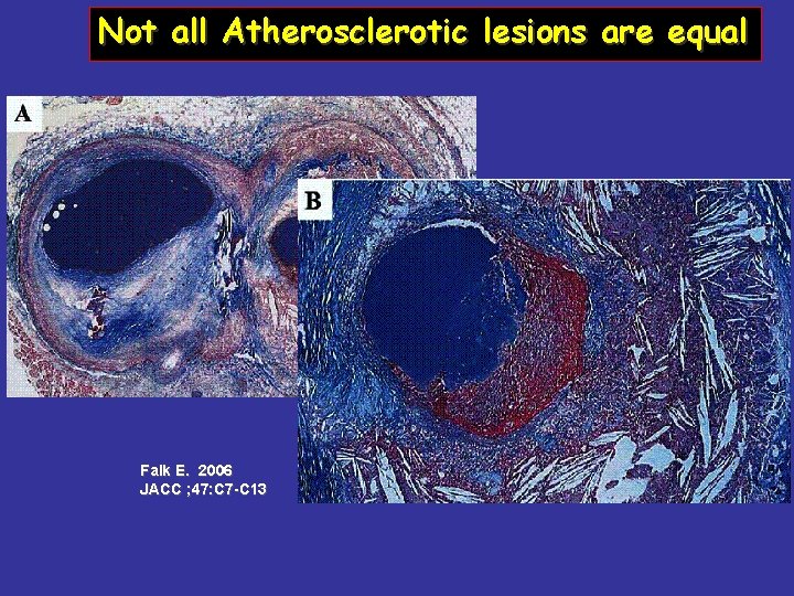 Not all Atherosclerotic lesions are equal Falk E. 2006 JACC ; 47: C 7