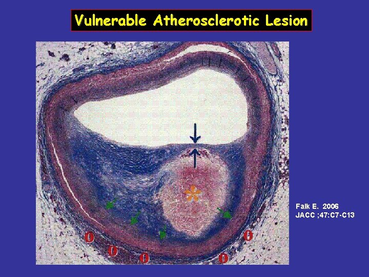 Vulnerable Atherosclerotic Lesion Falk E. 2006 JACC ; 47: C 7 -C 13 