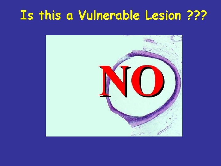 Is this a Vulnerable Lesion ? ? ? 