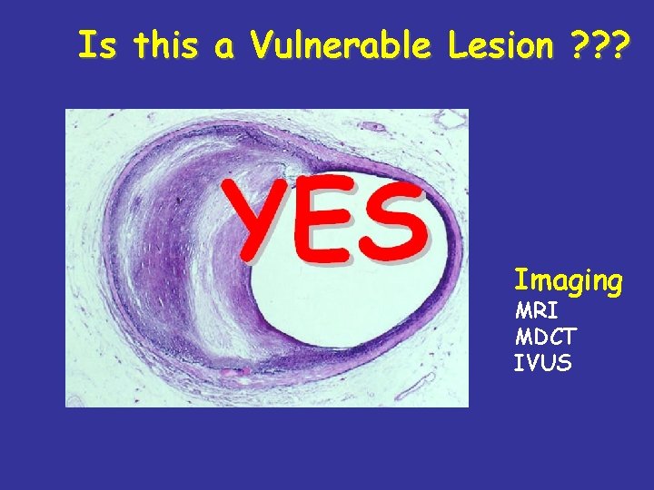 Is this a Vulnerable Lesion ? ? ? Imaging MRI MDCT IVUS 