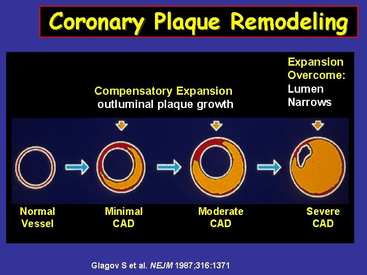 Coronary Plaque Remodeling Compensatory Expansion outluminal plaque growth Normal Vessel Minimal CAD Moderate CAD