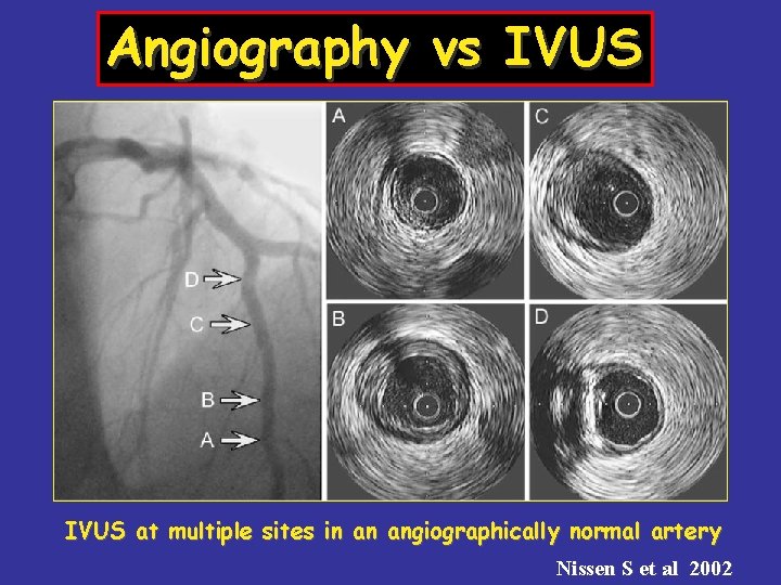 Angiography vs IVUS at multiple sites in an angiographically normal artery Nissen S et