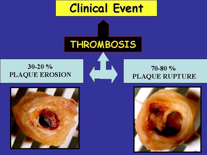 Clinical Event THROMBOSIS 30 -20 % PLAQUE EROSION 70 -80 % PLAQUE RUPTURE 