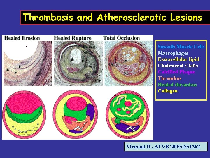 Thrombosis and Atherosclerotic Lesions Smooth Muscle Cells Macrophages Extracellular lipid Cholesterol Clefts Calcified Plaque