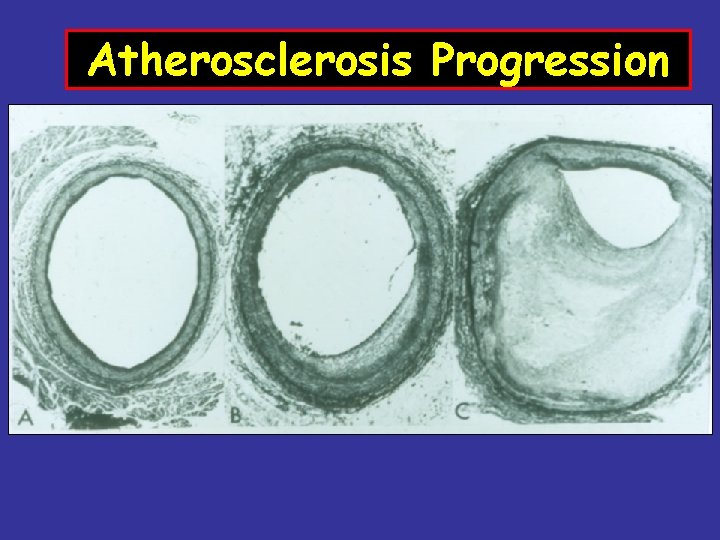 Atherosclerosis Progression 