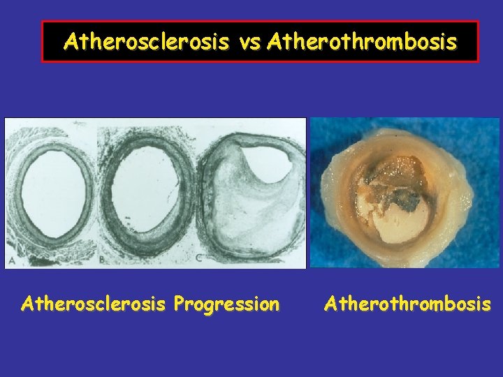 Atherosclerosis vs Atherothrombosis Atherosclerosis Progression Atherothrombosis 