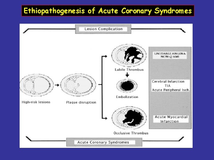 Ethiopathogenesis of Acute Coronary Syndromes 