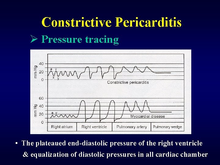 Constrictive Pericarditis Ø Pressure tracing • The plateaued end-diastolic pressure of the right ventricle