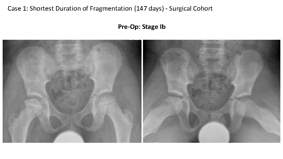 Case 1: Shortest Duration of Fragmentation (147 days) - Surgical Cohort Pre-Op: Stage Ib