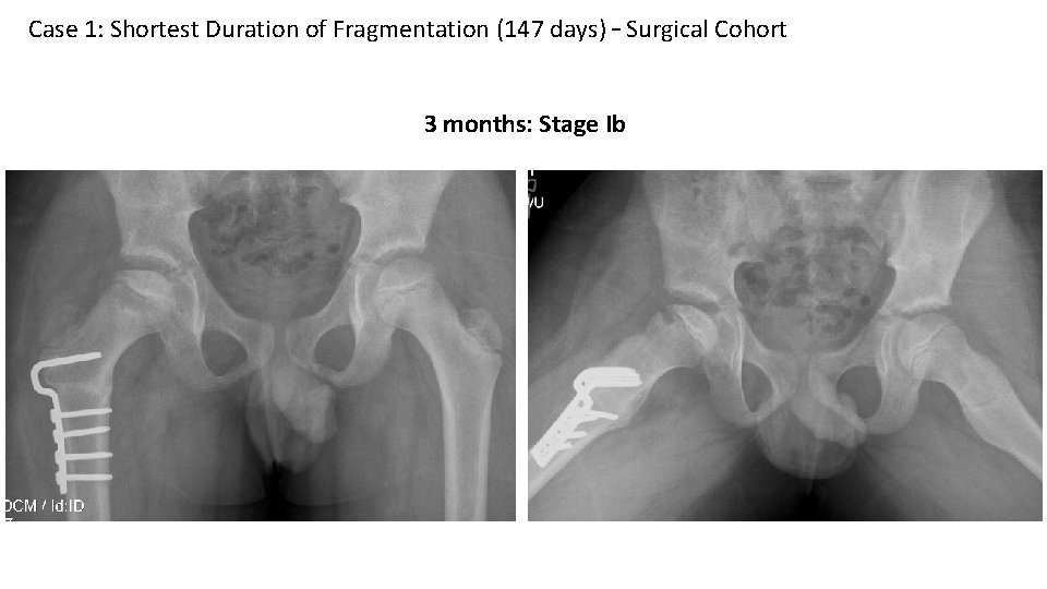 Case 1: Shortest Duration of Fragmentation (147 days) – Surgical Cohort 3 months: Stage