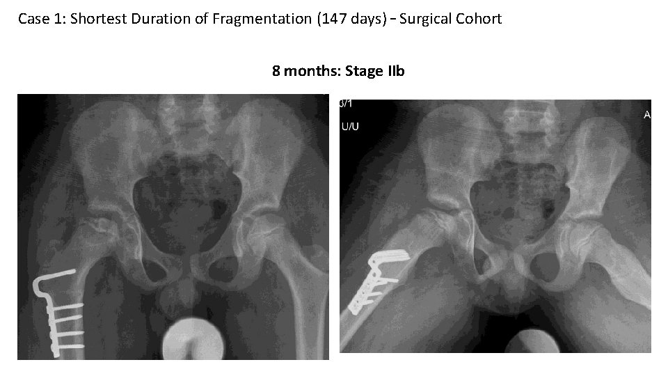 Case 1: Shortest Duration of Fragmentation (147 days) – Surgical Cohort 8 months: Stage