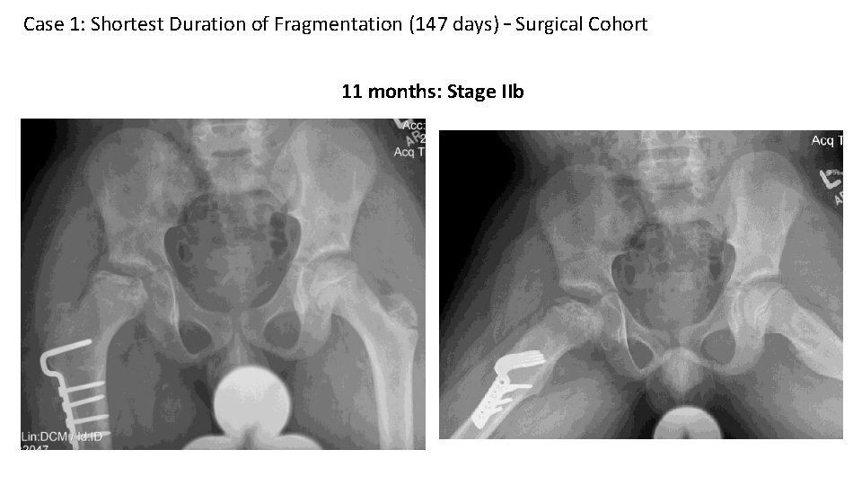 Case 1: Shortest Duration of Fragmentation (147 days) – Surgical Cohort 11 months: Stage