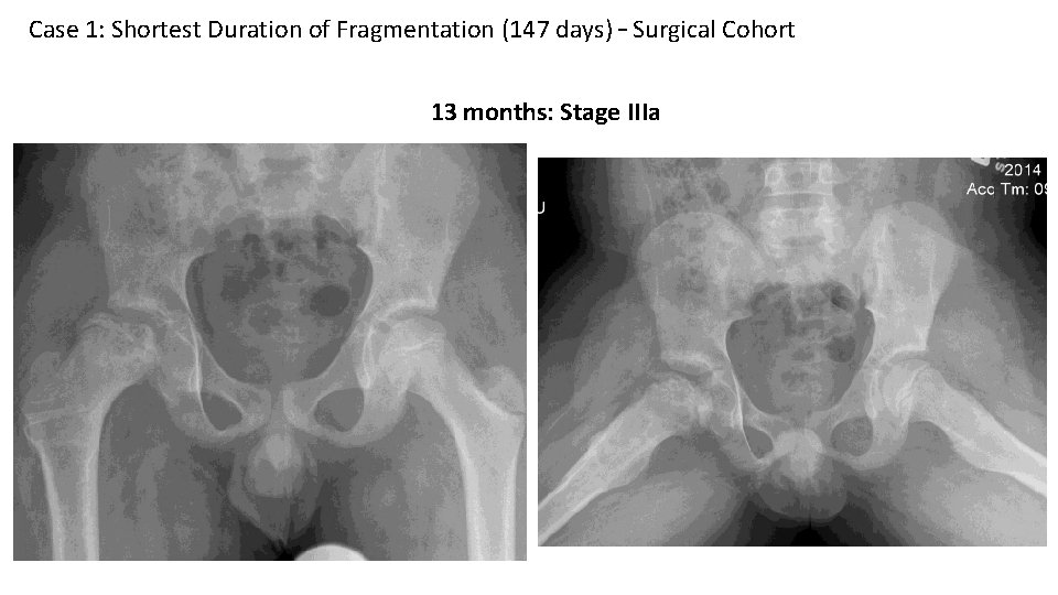 Case 1: Shortest Duration of Fragmentation (147 days) – Surgical Cohort 13 months: Stage