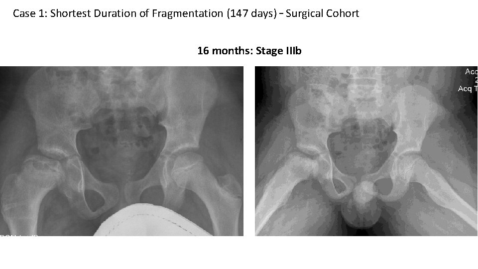 Case 1: Shortest Duration of Fragmentation (147 days) – Surgical Cohort 16 months: Stage