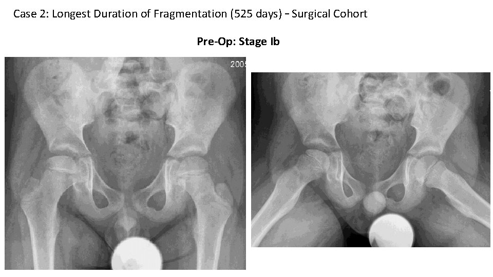 Case 2: Longest Duration of Fragmentation (525 days) – Surgical Cohort Pre-Op: Stage Ib