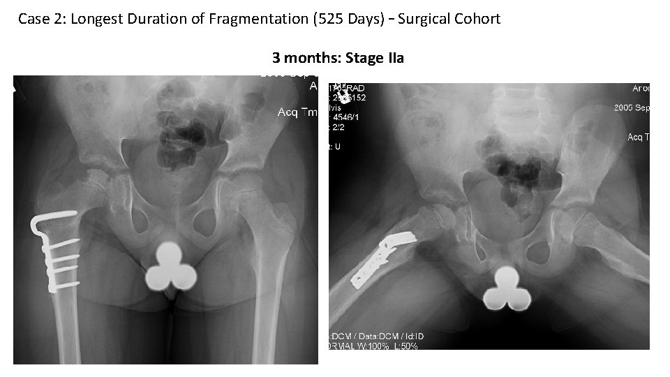 Case 2: Longest Duration of Fragmentation (525 Days) – Surgical Cohort 3 months: Stage