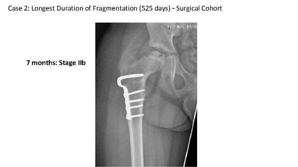 Case 2: Longest Duration of Fragmentation (525 days) – Surgical Cohort 7 months: Stage