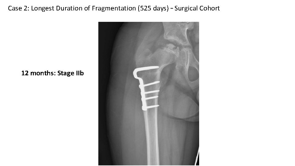 Case 2: Longest Duration of Fragmentation (525 days) – Surgical Cohort 12 months: Stage