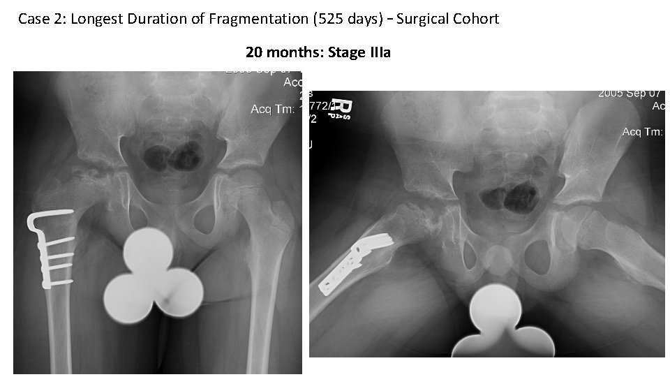 Case 2: Longest Duration of Fragmentation (525 days) – Surgical Cohort 20 months: Stage