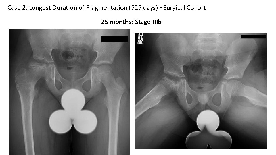 Case 2: Longest Duration of Fragmentation (525 days) – Surgical Cohort 25 months: Stage