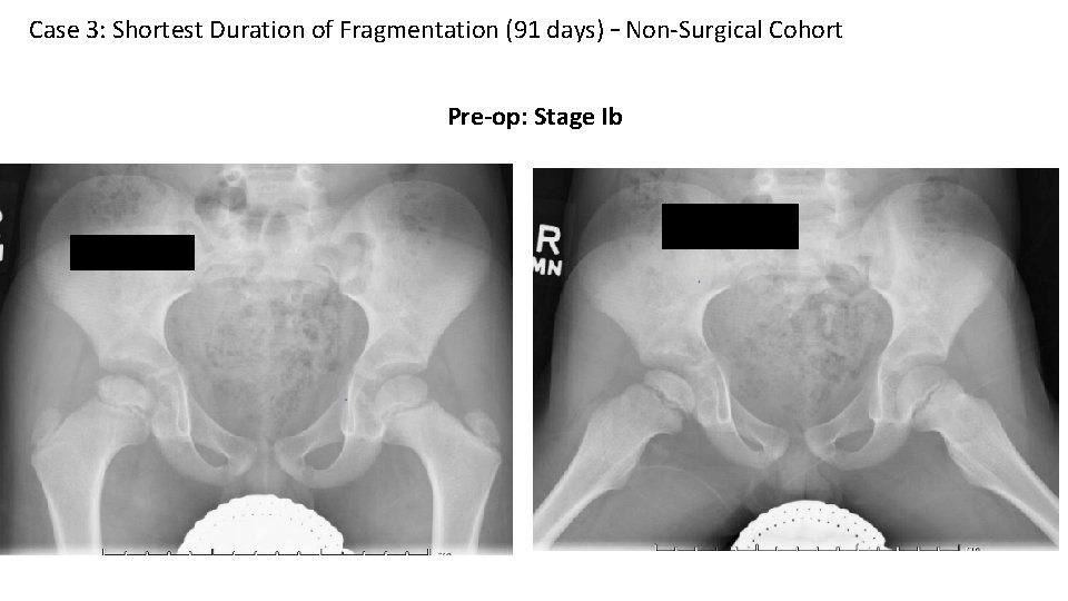 Case 3: Shortest Duration of Fragmentation (91 days) – Non-Surgical Cohort Pre-op: Stage Ib