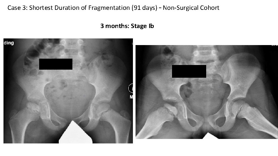 Case 3: Shortest Duration of Fragmentation (91 days) – Non-Surgical Cohort 3 months: Stage